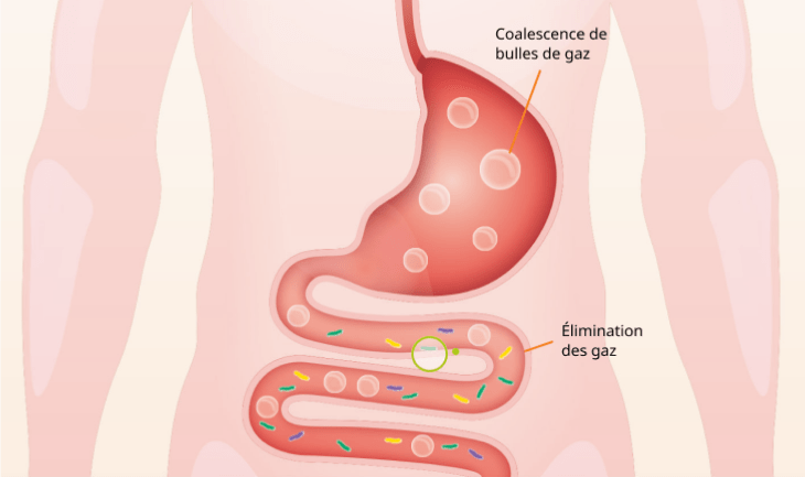Illustration montrant des bulles de gaz responsable de l'inconfort abdominal